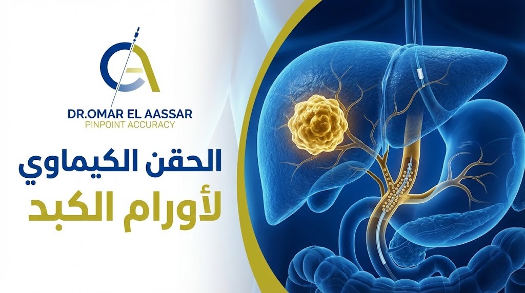 الحقن الكيماوي لاورام الكبد
