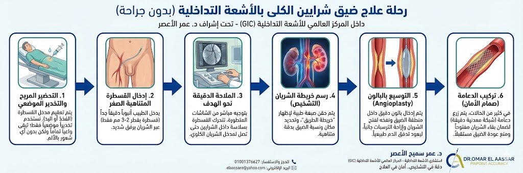 خطوات عملية توسيع شرايين الكلى بالأشعة التداخلية